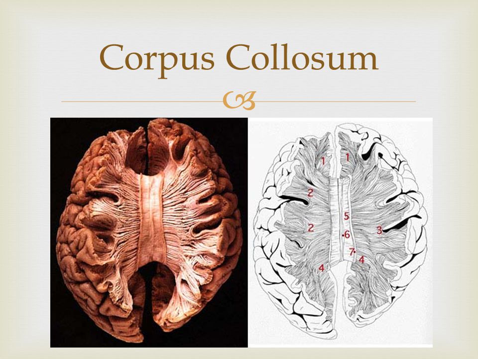  Corpus Collosum
