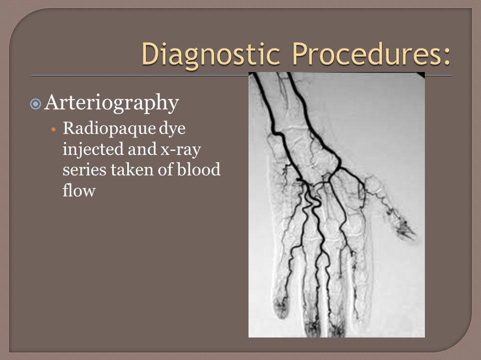  Arteriography Radiopaque dye injected and x-ray series taken of blood flow