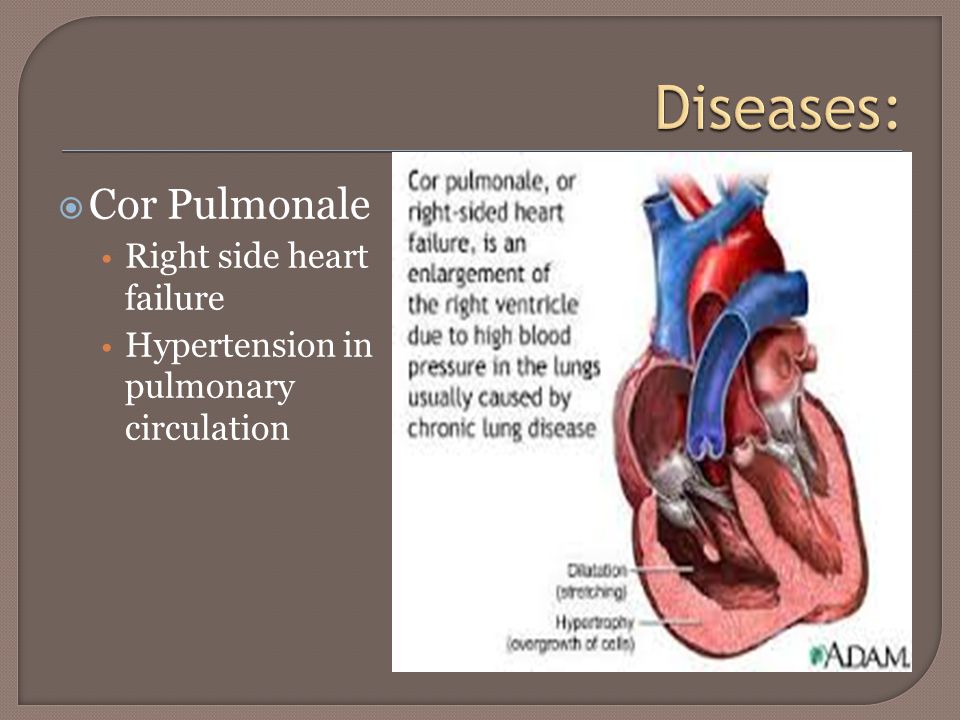  Cor Pulmonale Right side heart failure Hypertension in pulmonary circulation