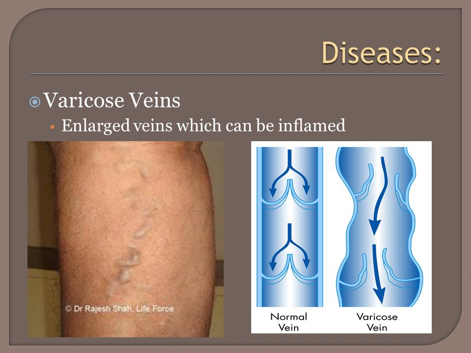  Varicose Veins Enlarged veins which can be inflamed