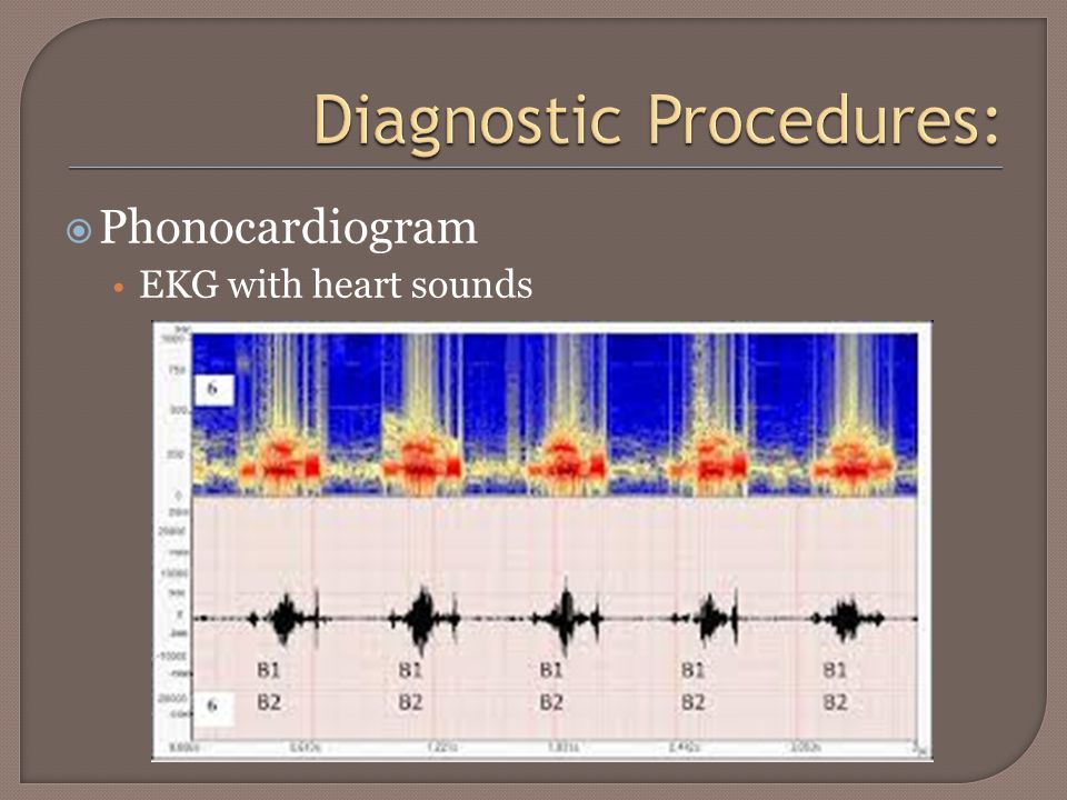  Phonocardiogram EKG with heart sounds
