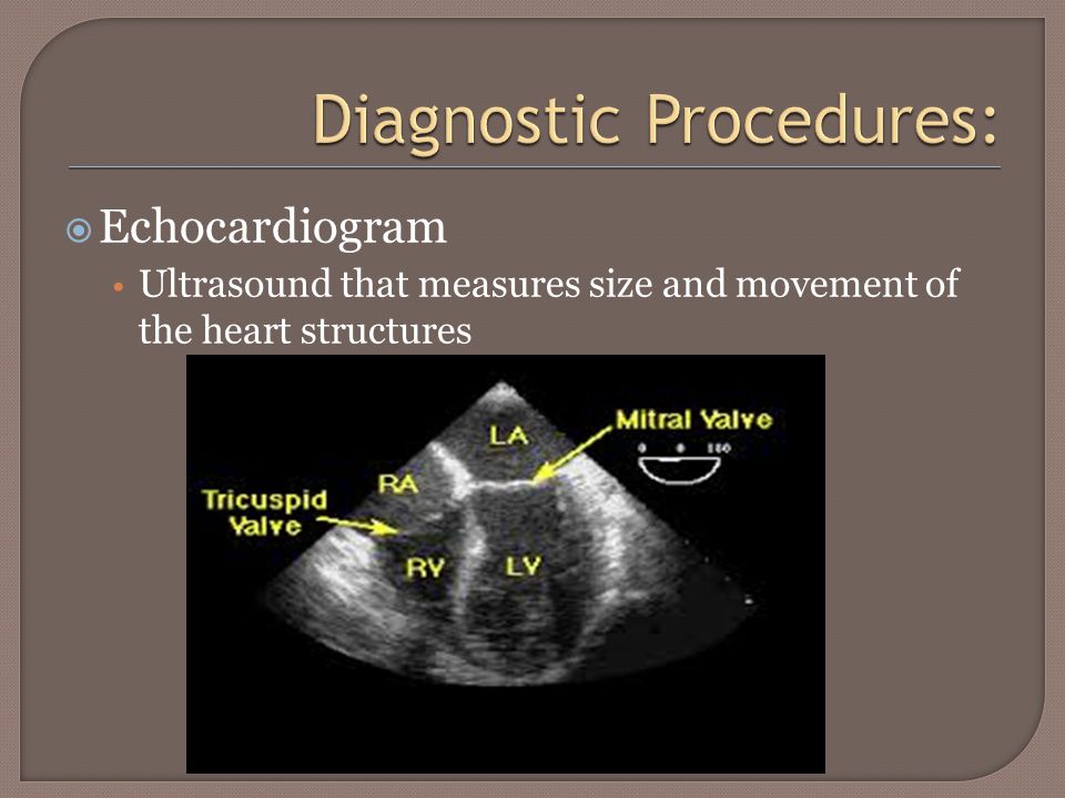  Echocardiogram Ultrasound that measures size and movement of the heart structures
