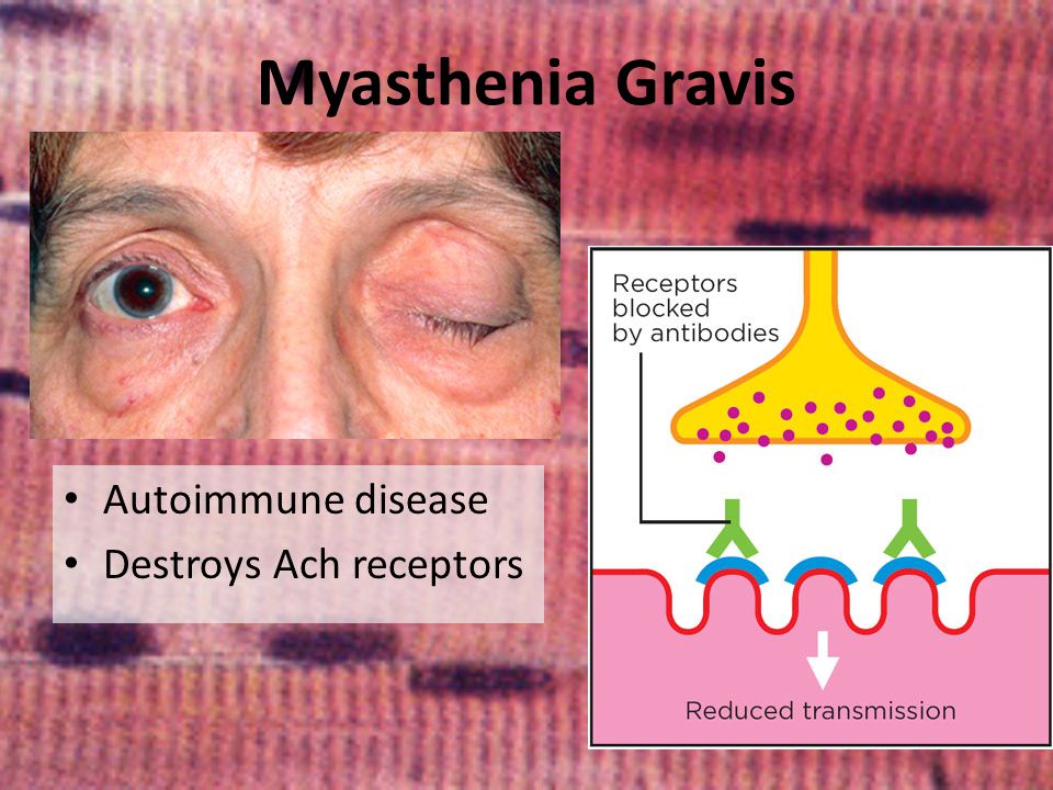 myasthenia gravis oogklachten