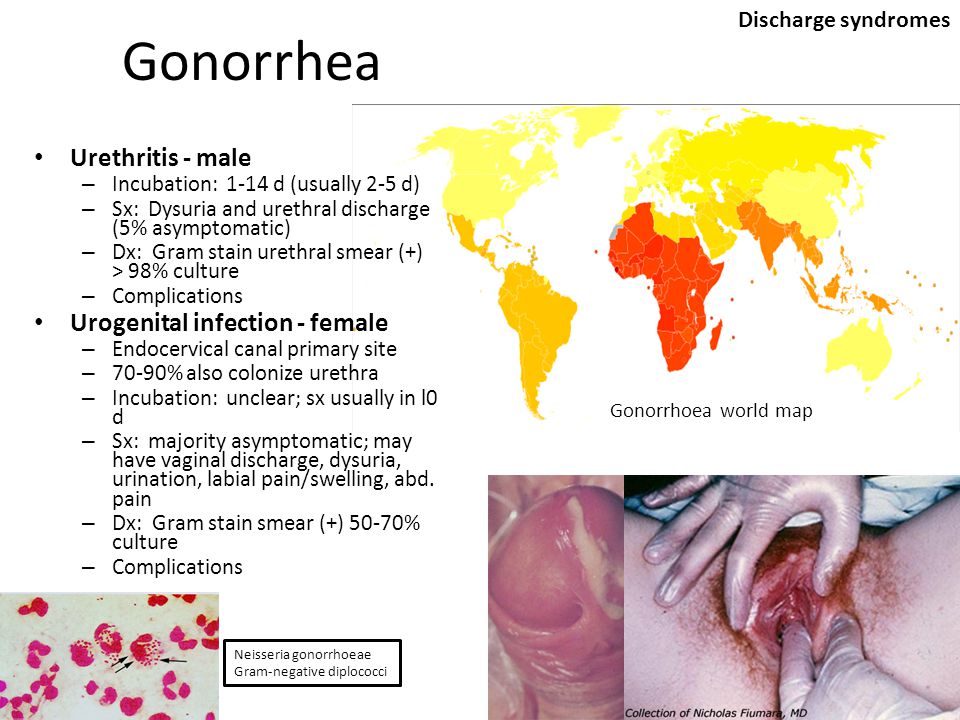 Hiv through the uretha