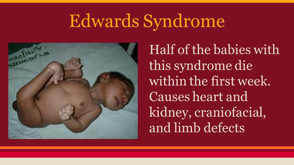 edwards syndrome edwards syndrome