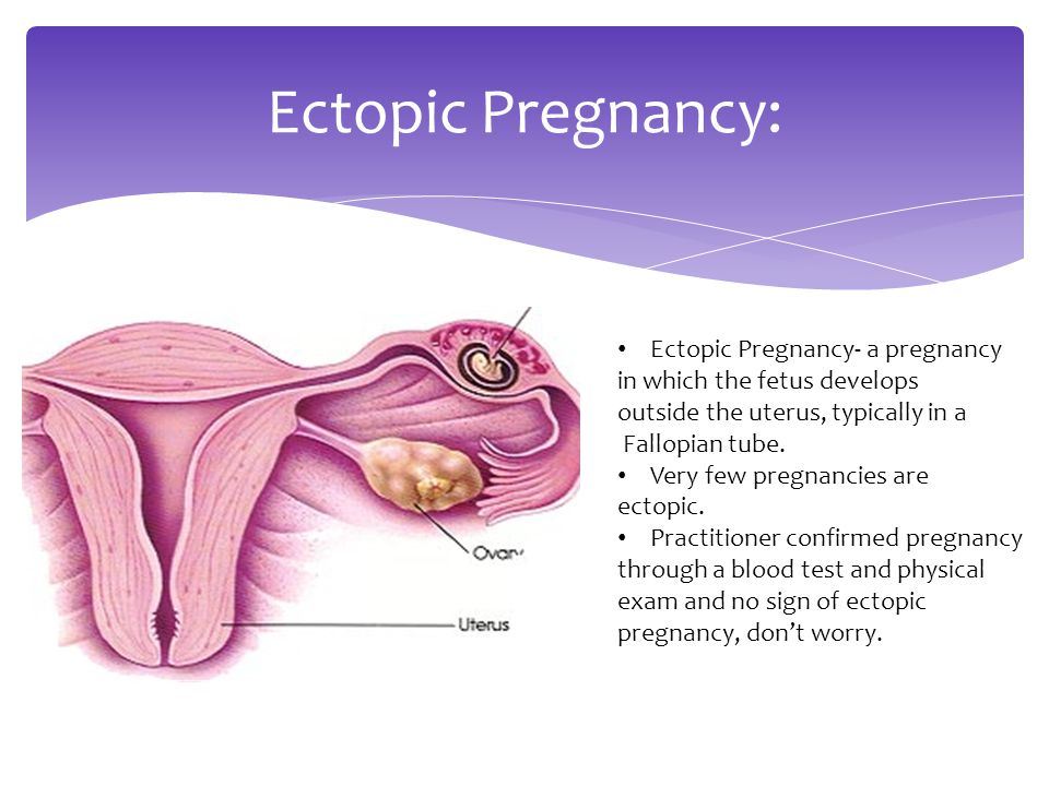 Ectopic Pregnancy: Ectopic Pregnancy- a pregnancy in which the fetus develops outside the uterus, typically in a Fallopian tube.