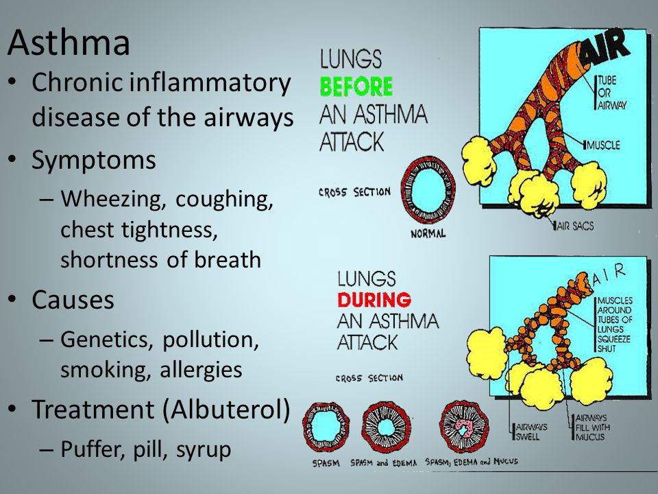 Asthma Chronic inflammatory disease of the airways Symptoms – Wheezing, coughing, chest tightness, shortness of breath Causes – Genetics, pollution, smoking, allergies Treatment (Albuterol) – Puffer, pill, syrup