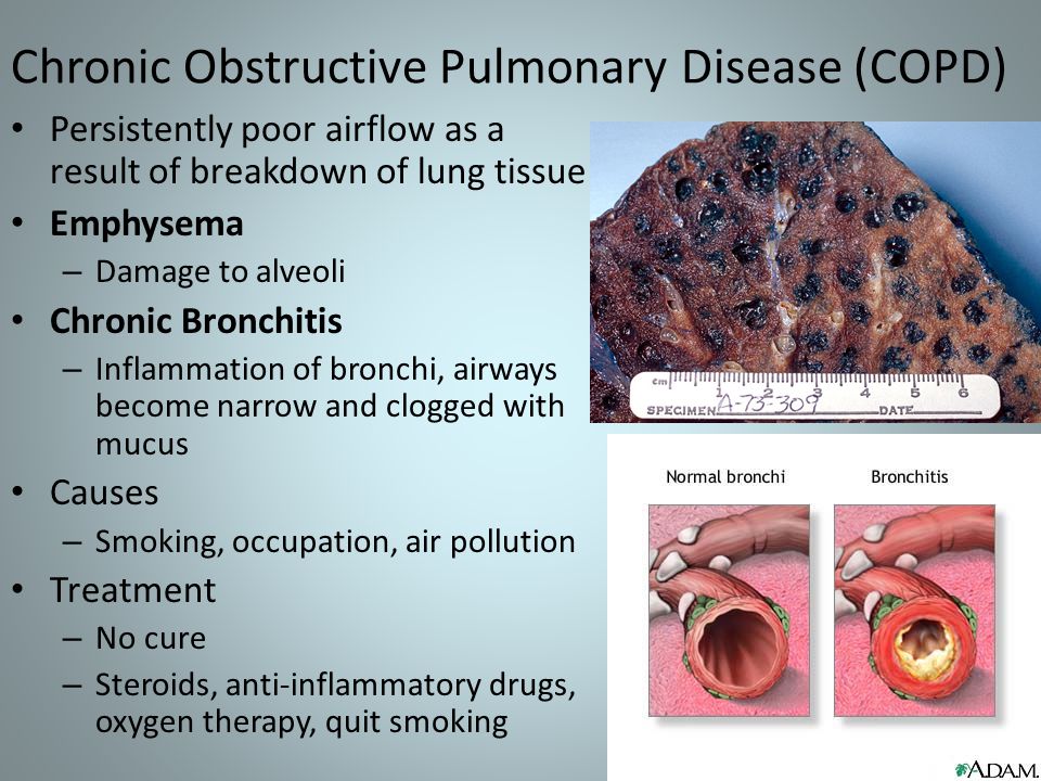 Chronic Obstructive Pulmonary Disease (COPD) Persistently poor airflow as a result of breakdown of lung tissue Emphysema – Damage to alveoli Chronic Bronchitis – Inflammation of bronchi, airways become narrow and clogged with mucus Causes – Smoking, occupation, air pollution Treatment – No cure – Steroids, anti-inflammatory drugs, oxygen therapy, quit smoking