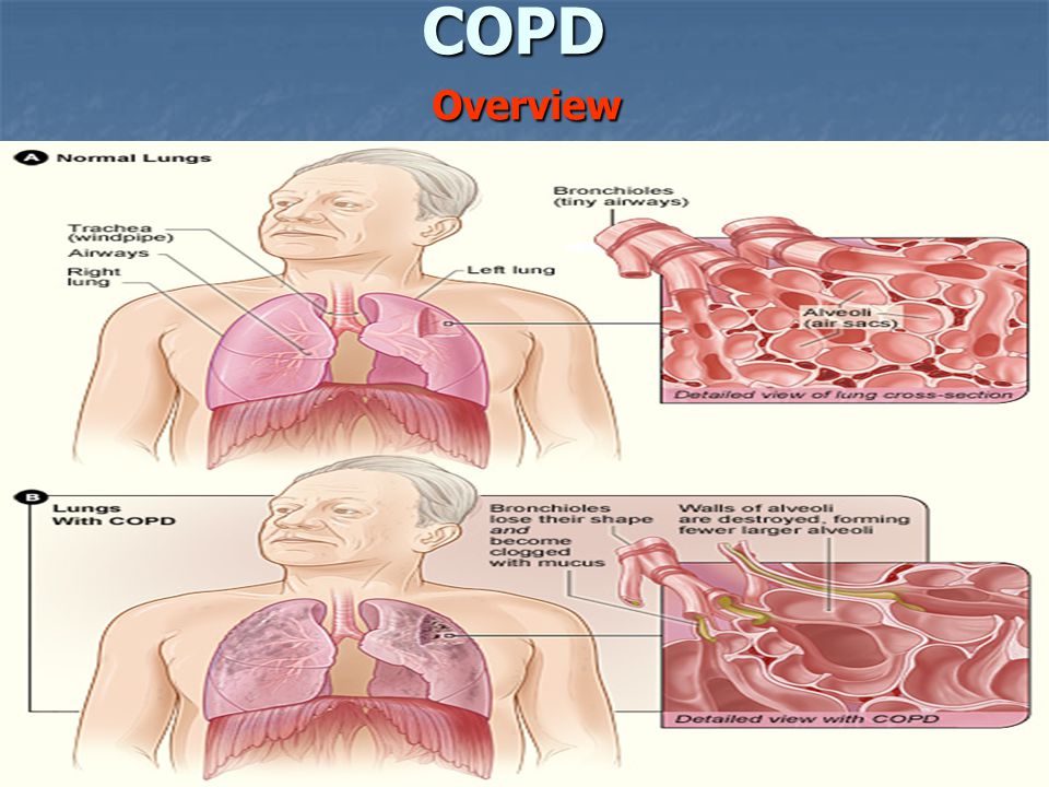 COPD Overview