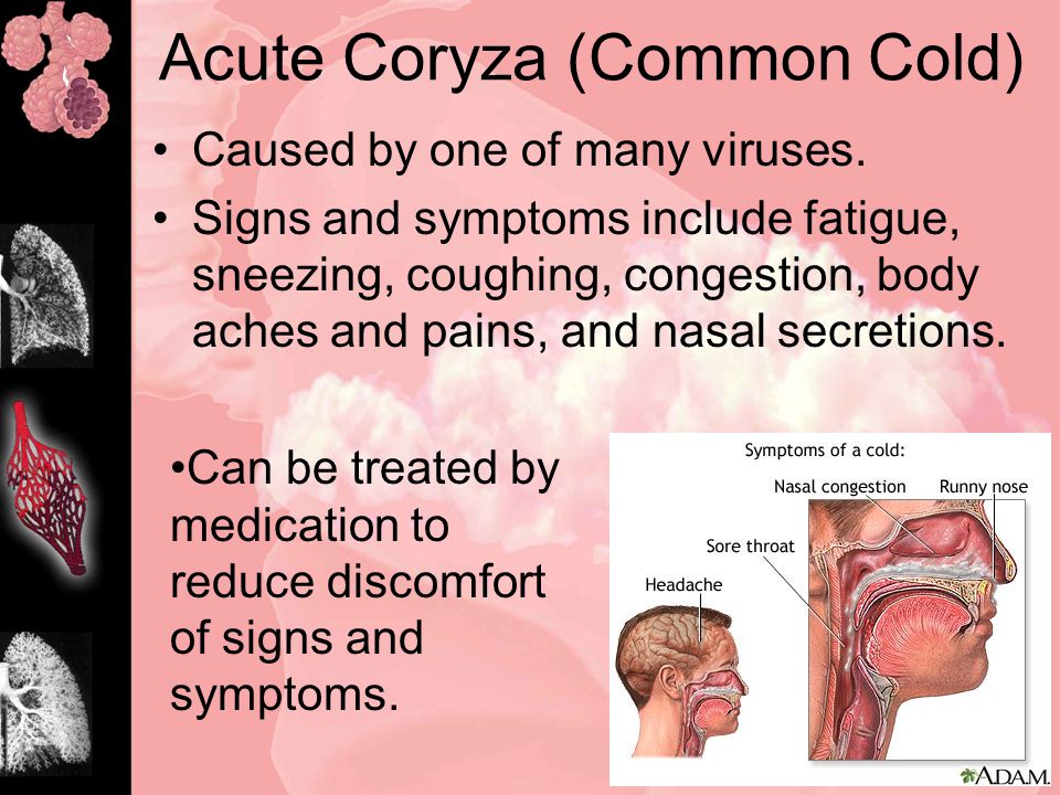 Acute Coryza (Common Cold) Caused by one of many viruses.