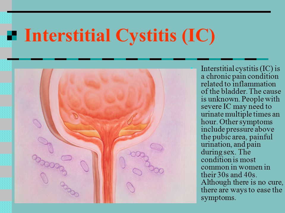 Sex interstitial cystitis