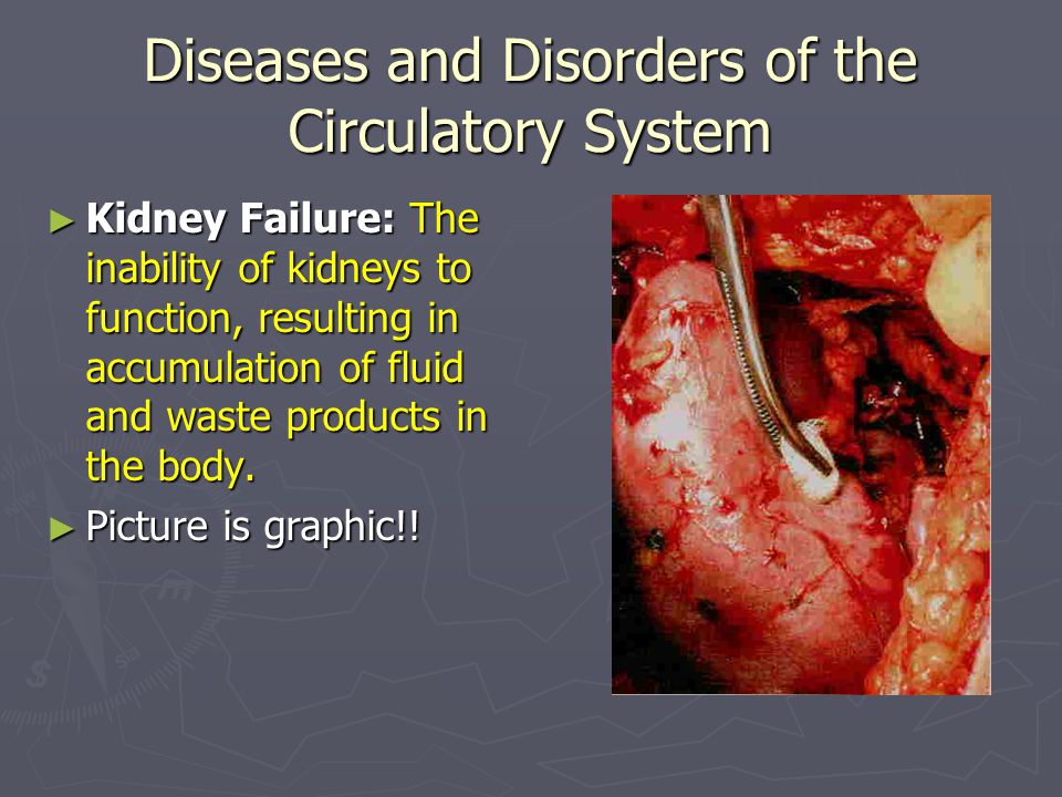 Diseases and Disorders of the Circulatory System ► Kidney Failure: The inability of kidneys to function, resulting in accumulation of fluid and waste products in the body.