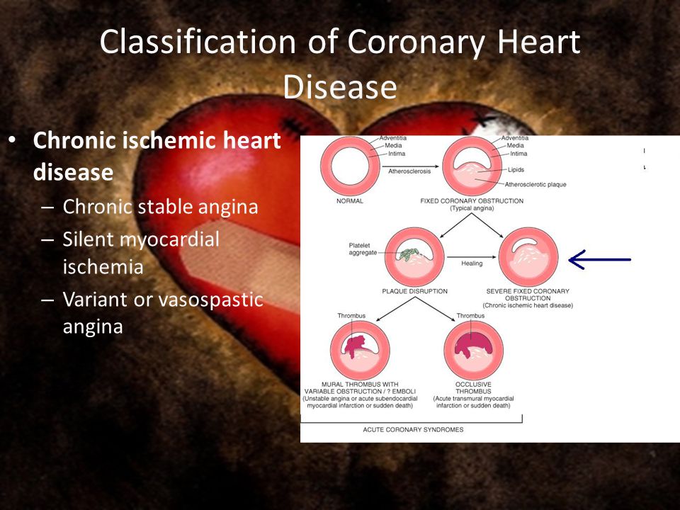 literature review on coronary heart disease Pathophysiology of coronary heart disease: a brief review or cited in the literature emerging evidence strongly suggests that coronary heart disease. literature review on coronary heart disease Pathophysiology of coronary heart disease: a brief review or cited in the literature emerging evidence strongly suggests that coronary heart disease.