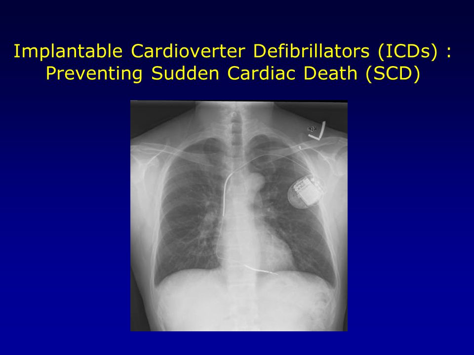 Implantable Cardioverter Defibrillators (ICDs) : Preventing Sudden Cardiac Death (SCD)