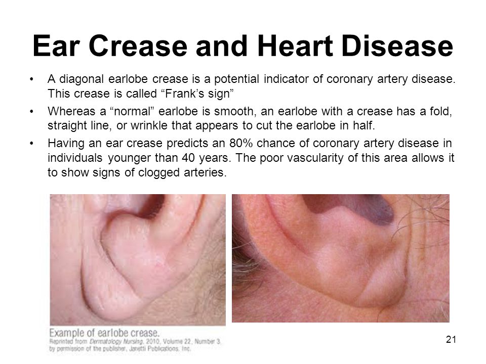 Image result for Famous peoples' diagonal earlobe crease