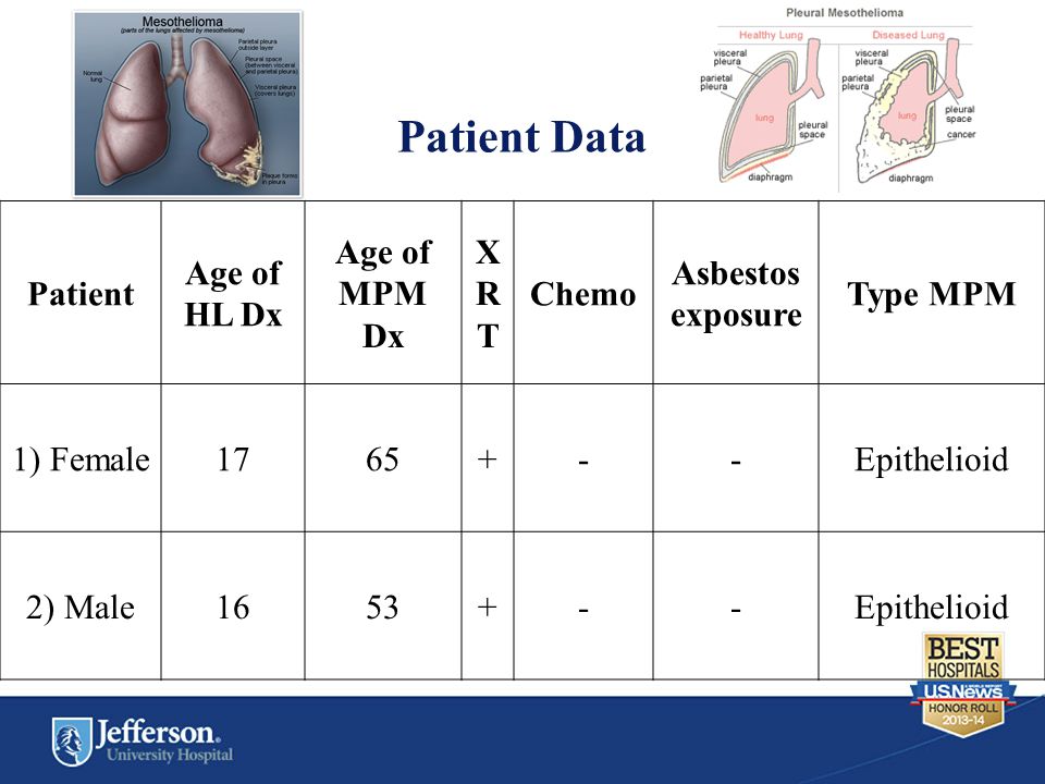 Patient Data Patient Age of HL Dx Age of MPM Dx XRTXRT Chemo Asbestos exposure Type MPM 1) Female Epithelioid 2) Male Epithelioid