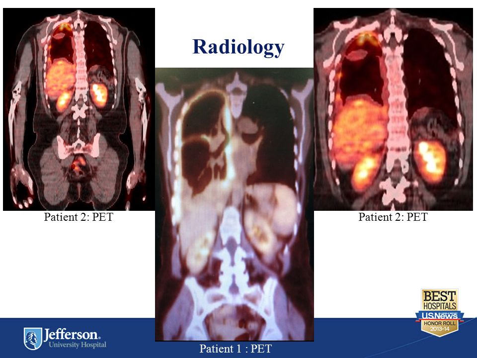 Radiology Patient 2: PET Patient 1 : PET
