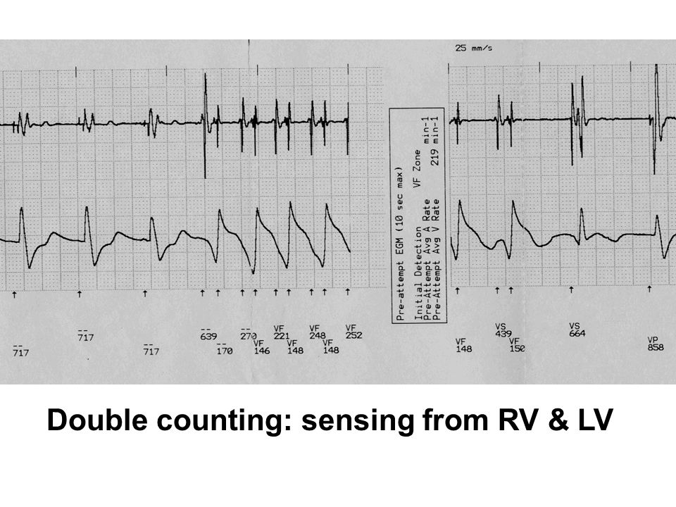 Double counting: sensing from RV & LV