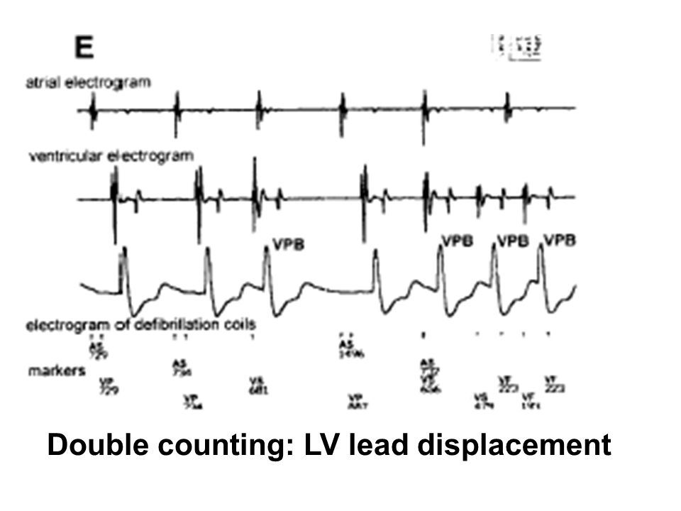 Double counting: LV lead displacement