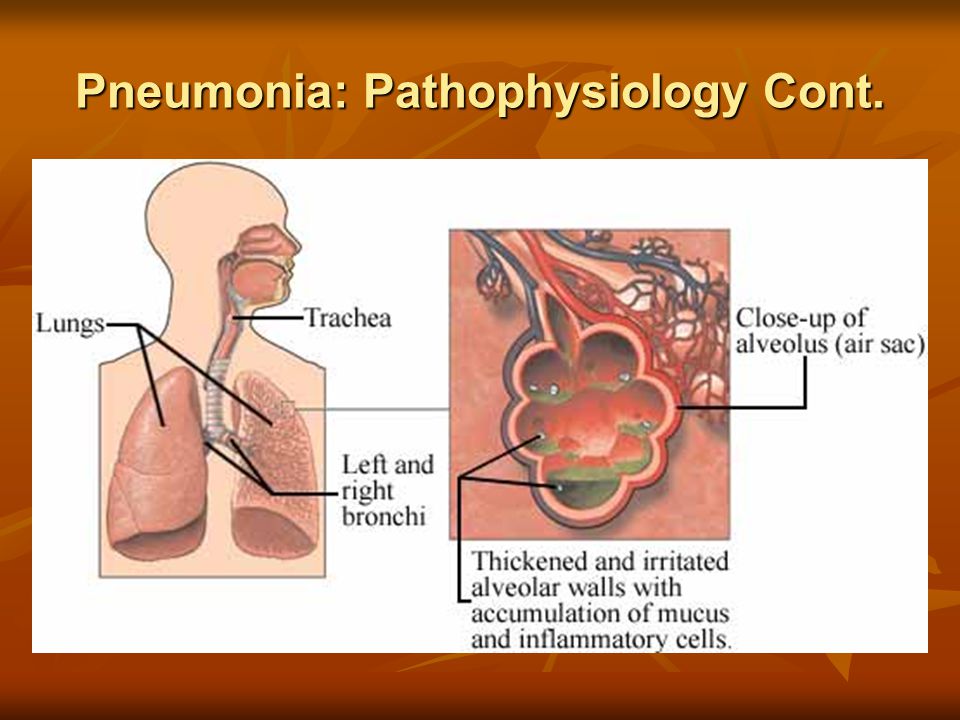 Pneumonia: Pathophysiology Cont.