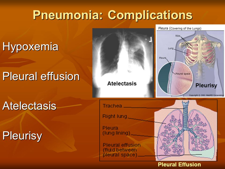 Pneumonia: Complications Hypoxemia Pleural effusion AtelectasisPleurisy Atelectasis Pleurisy Pleural Effusion
