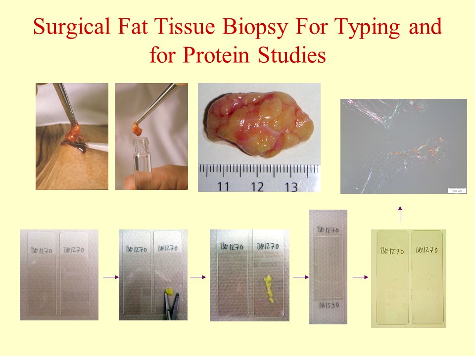 Surgical Fat Tissue Biopsy For Typing and for Protein Studies