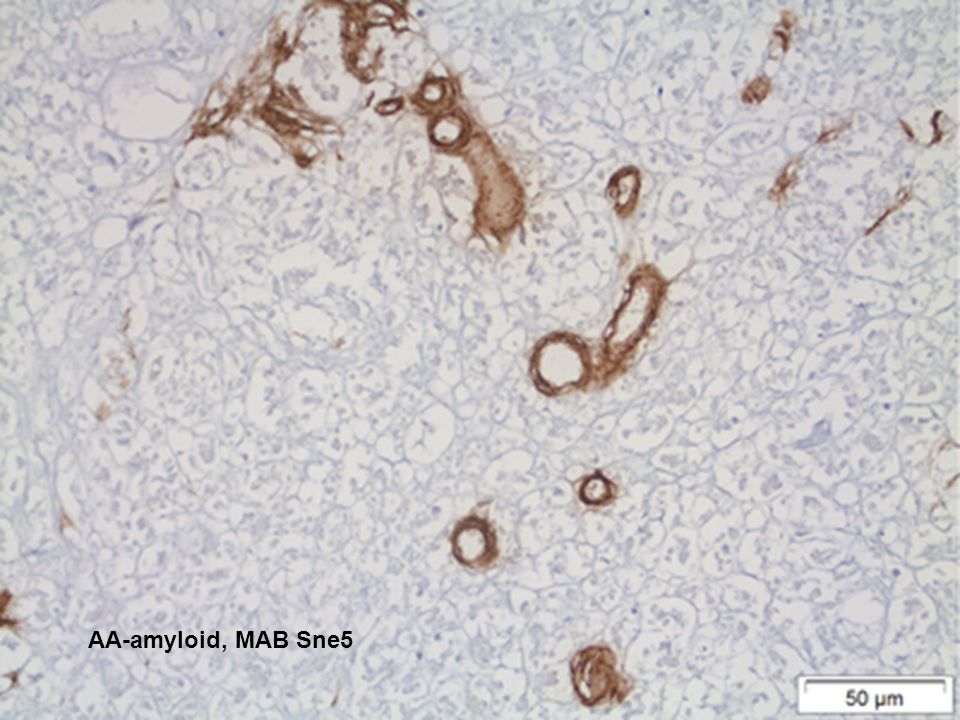 AA-amyloid, MAB Sne5