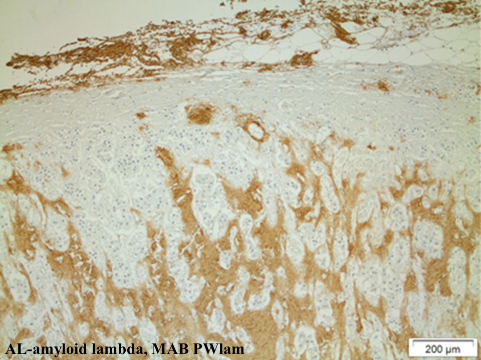 AL-amyloid lambda, MAB PWlam