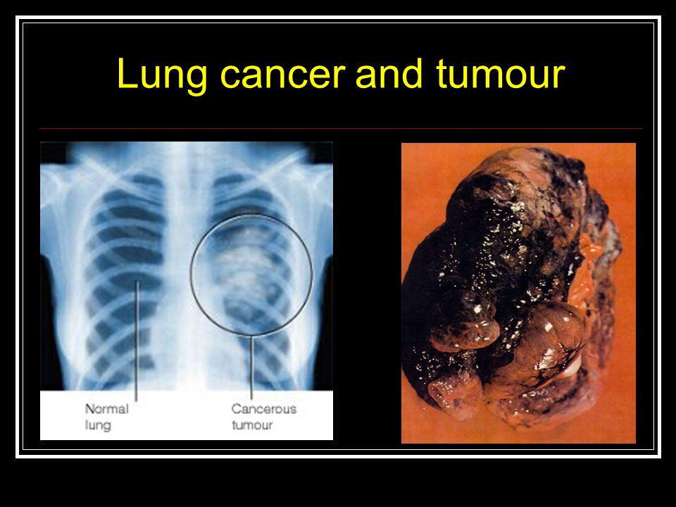 Lung cancer and tumour