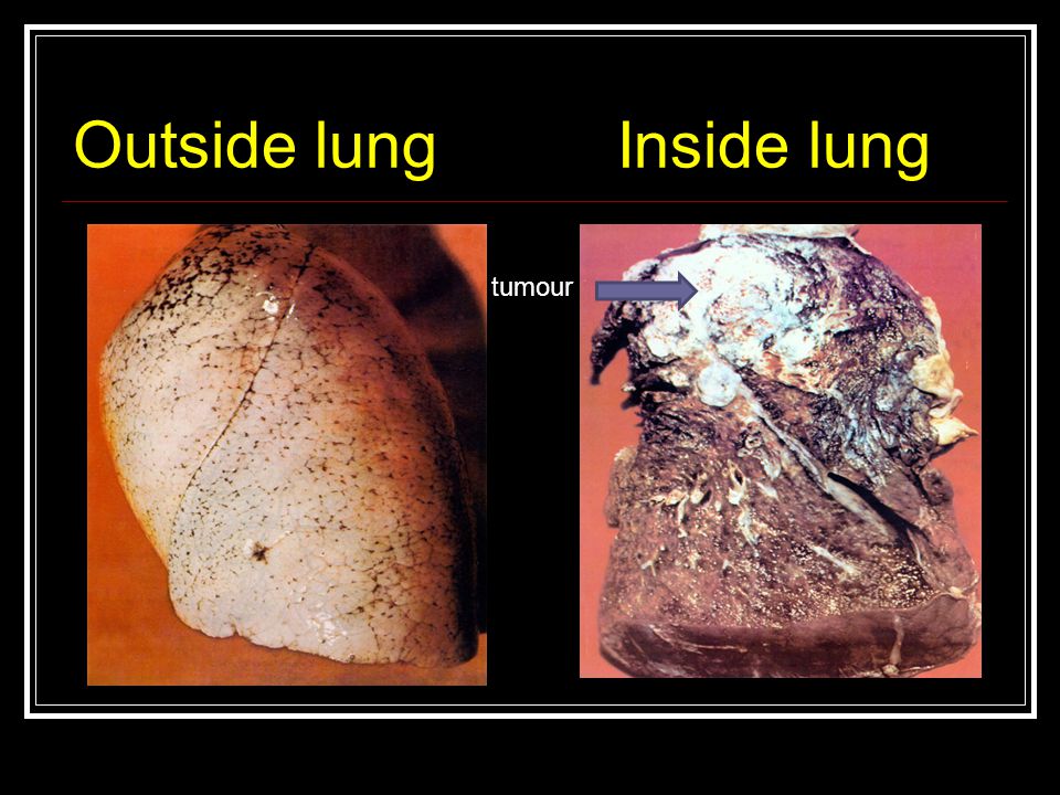 Outside lung Inside lung tumour