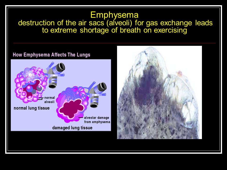 Emphysema destruction of the air sacs (alveoli) for gas exchange leads to extreme shortage of breath on exercising