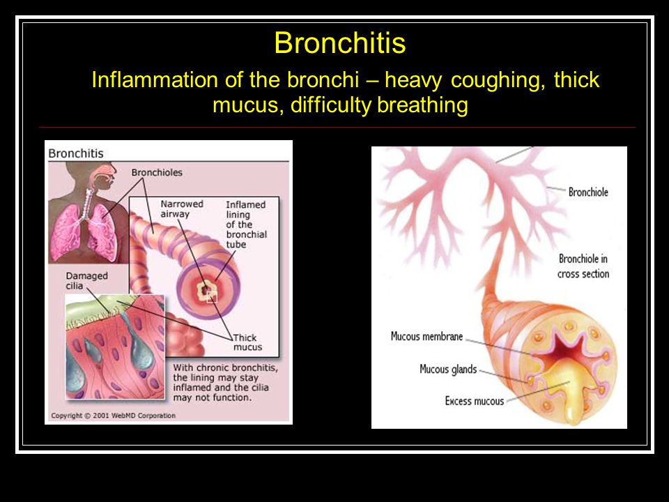 Bronchitis Inflammation of the bronchi – heavy coughing, thick mucus, difficulty breathing