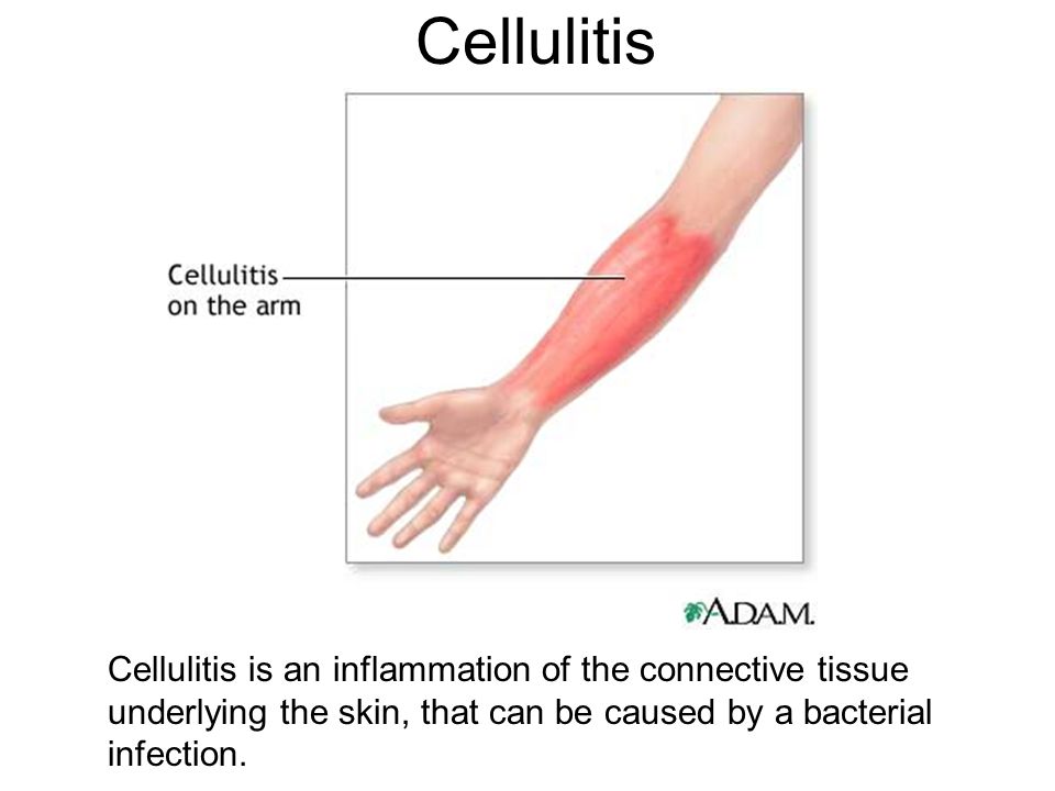 Cellulitis Cellulitis is an inflammation of the connective tissue ...