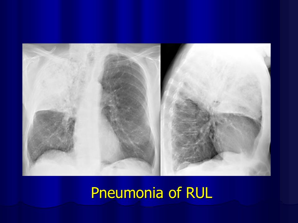 Pneumonia of RUL