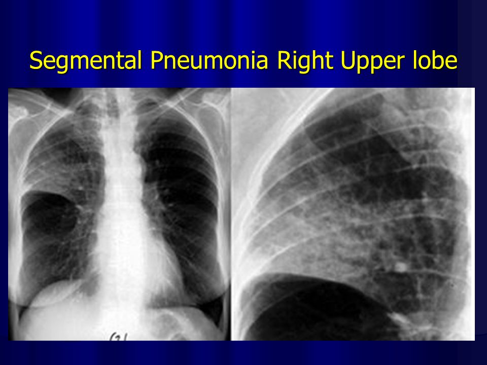 Segmental Pneumonia Right Upper lobe