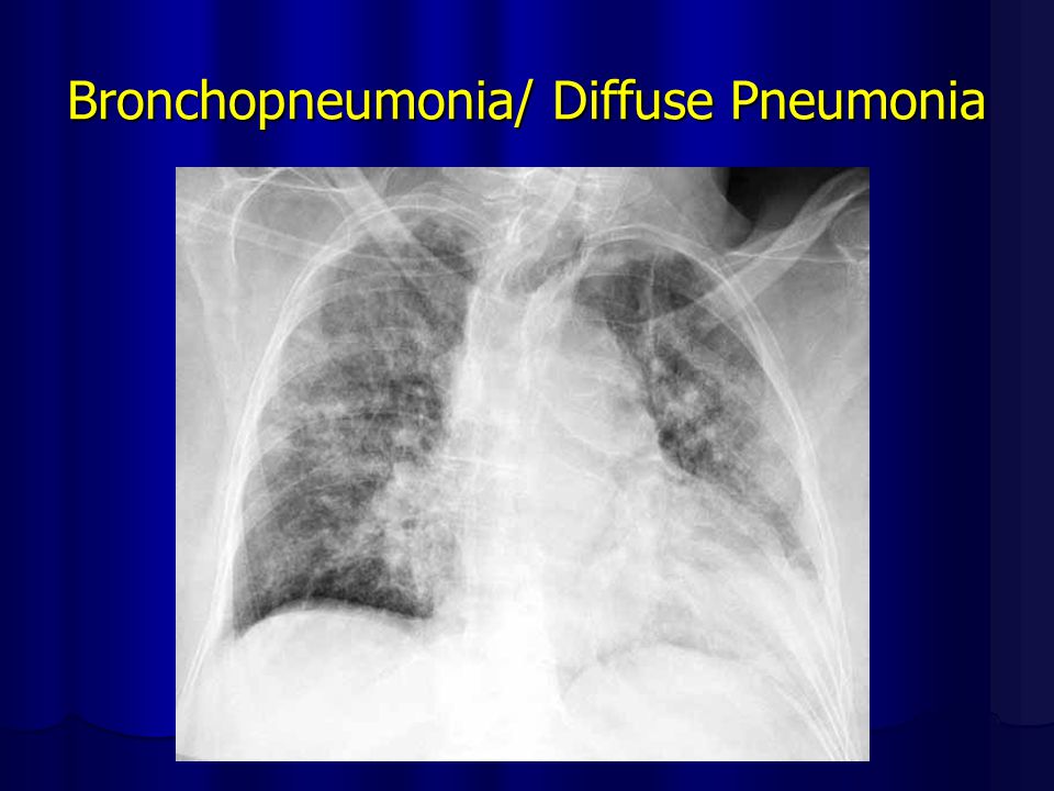 Bronchopneumonia/ Diffuse Pneumonia