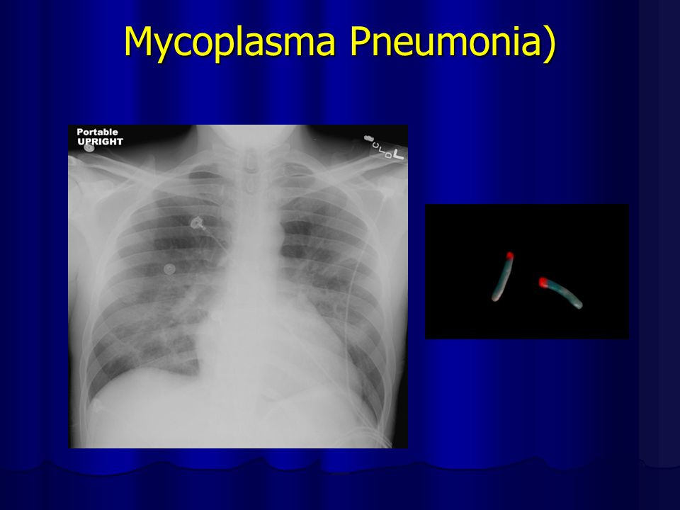 Mycoplasma Pneumonia)