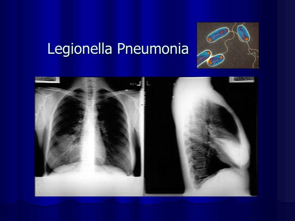 Legionella Pneumonia