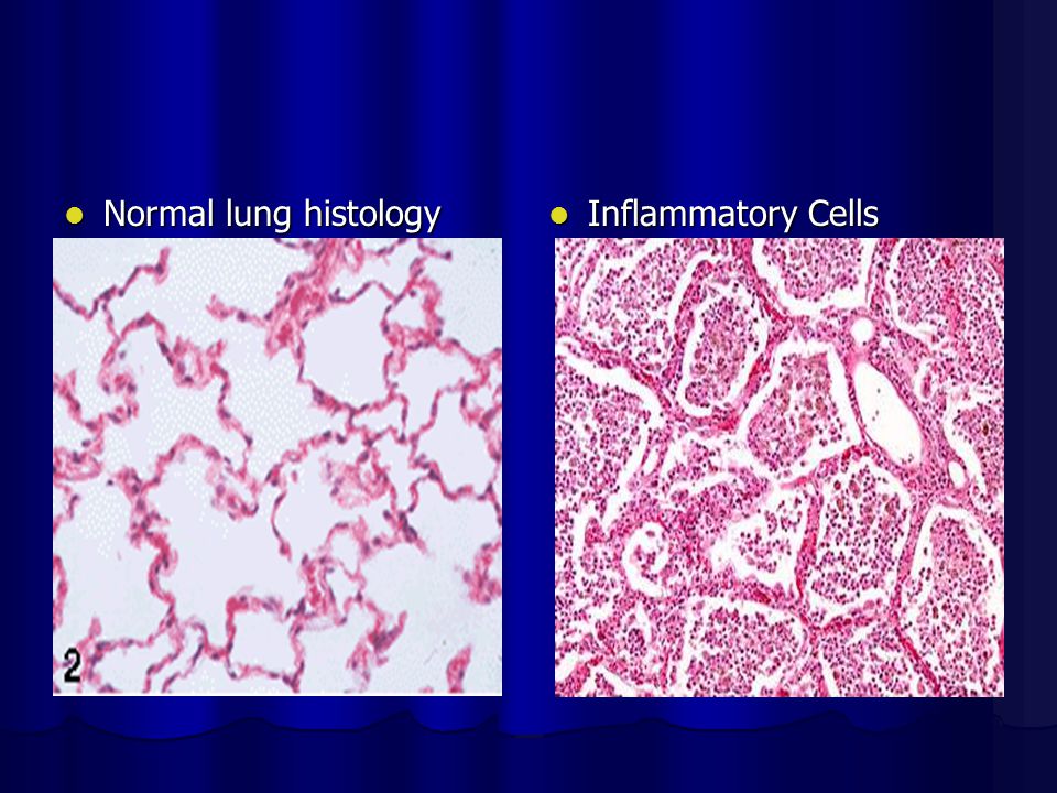 Normal lung histology Normal lung histology Inflammatory Cells lsPneumonia Inflammatory Cells lsPneumonia