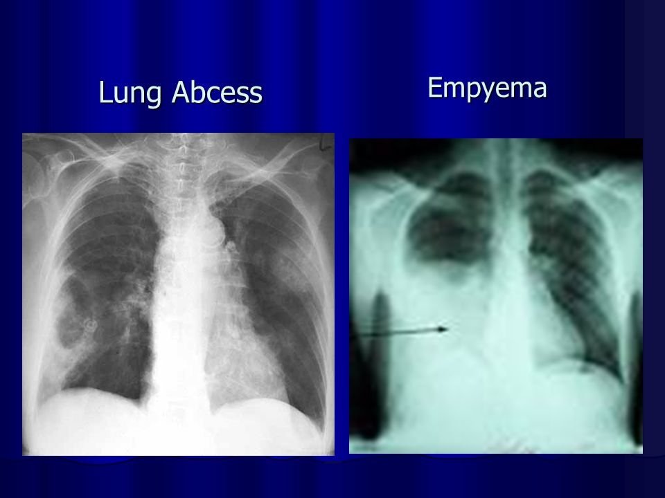 Lung Abcess Empyema