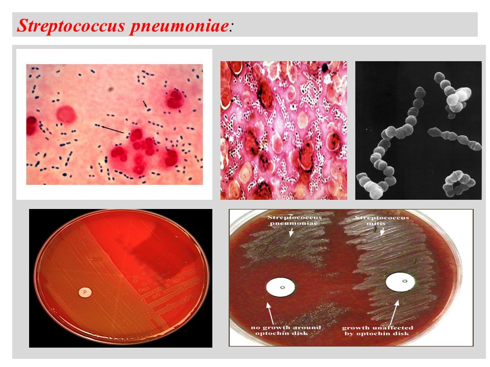 Streptococcus pneumoniae: a