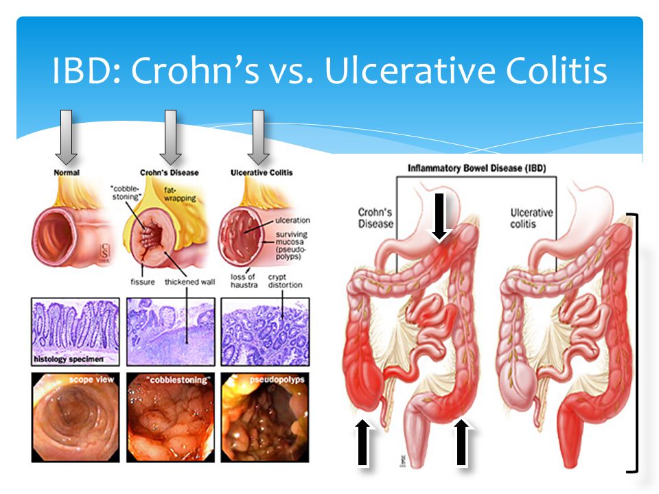 the symptoms and treatment of inflammatory bowel disease As with other chronic diseases, a person with inflammatory bowel disease will generally go through periods in which the disease flares up and causes symptoms, followed by periods in which symptoms dec. the symptoms and treatment of inflammatory bowel disease As with other chronic diseases, a person with inflammatory bowel disease will generally go through periods in which the disease flares up and causes symptoms, followed by periods in which symptoms dec.