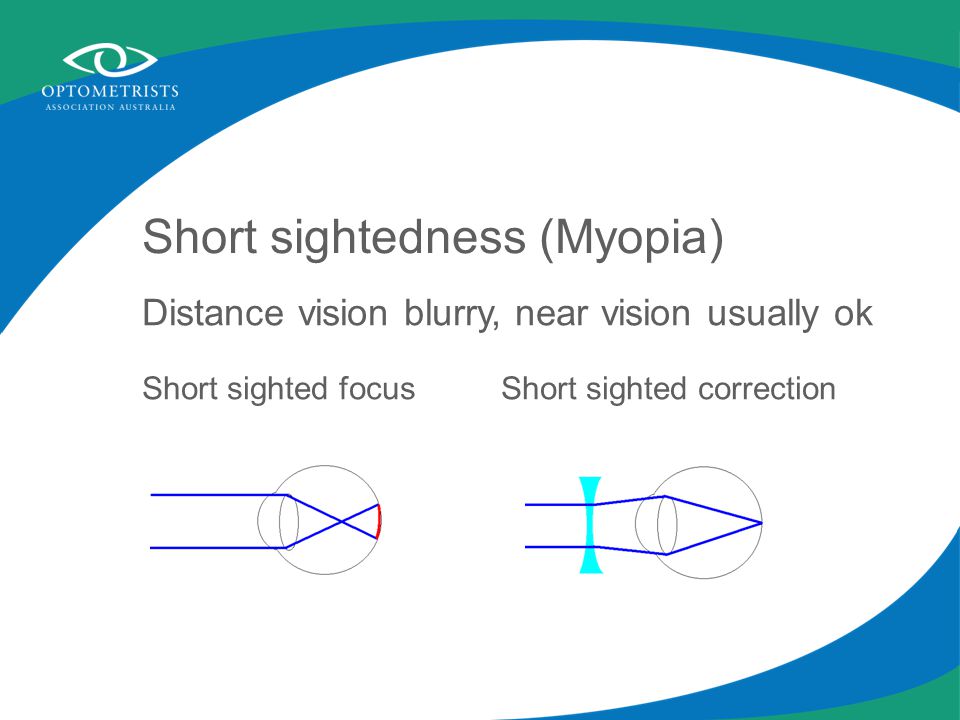 Short sightedness (Myopia) Distance vision blurry, near vision usually ok Short sighted focus Short sighted correction
