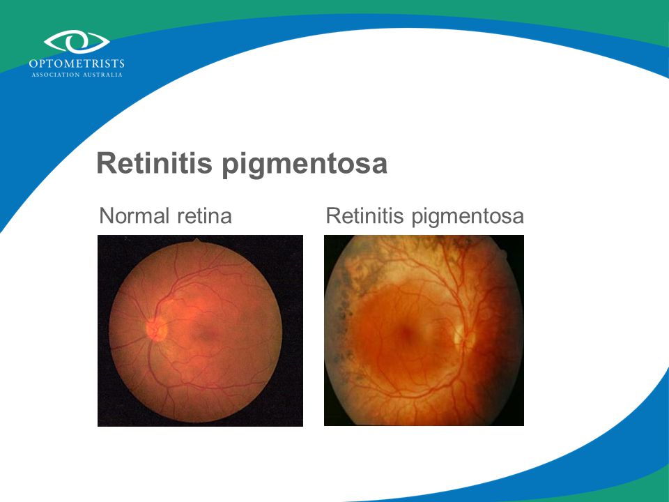 Retinitis pigmentosa Normal retinaRetinitis pigmentosa