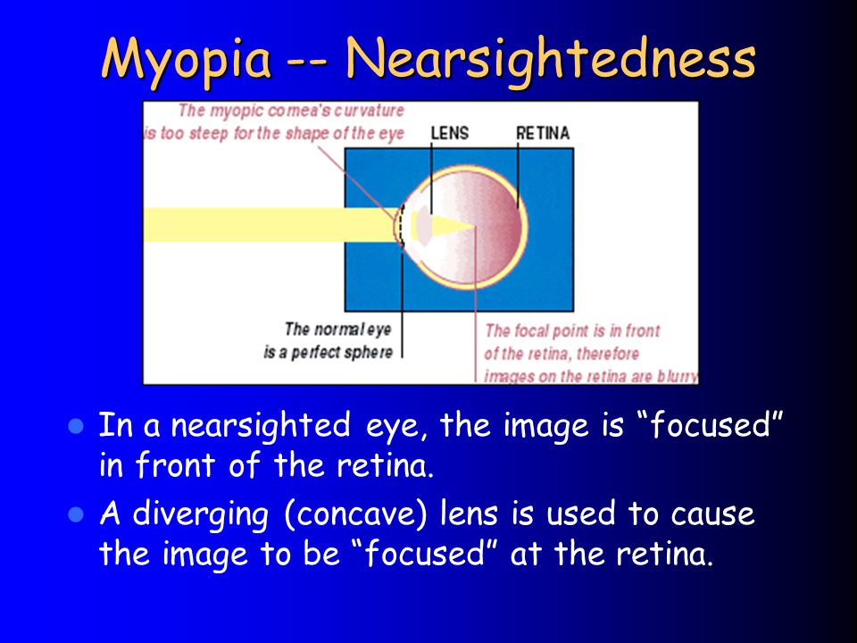Myopia -- Nearsightedness In a nearsighted eye, the image is focused in front of the retina.