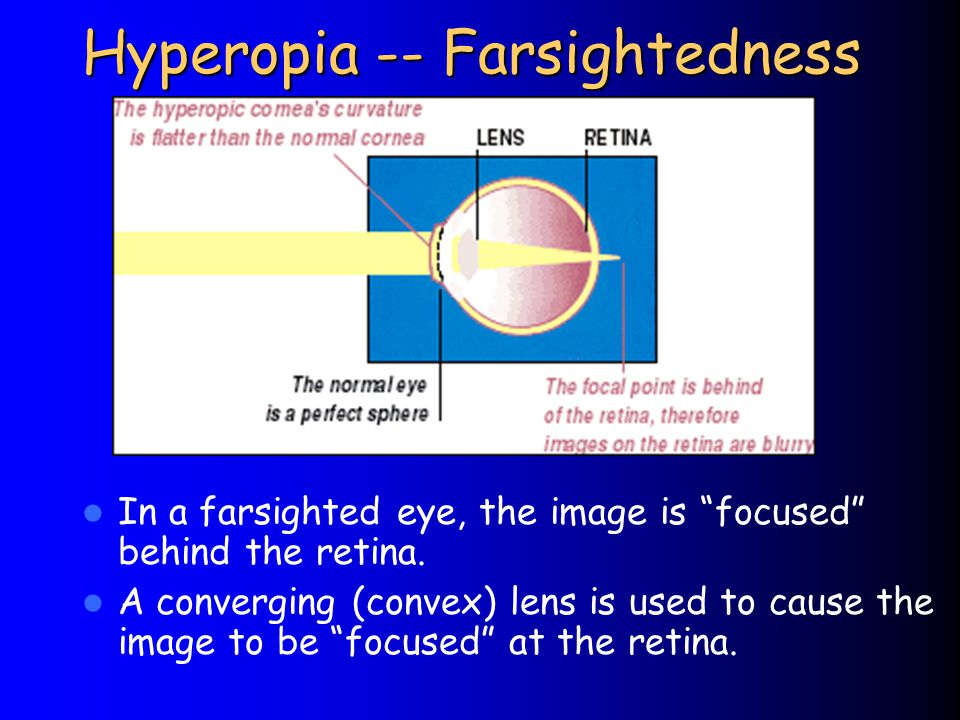 Hyperopia -- Farsightedness In a farsighted eye, the image is focused behind the retina.