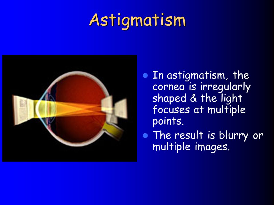 Astigmatism In astigmatism, the cornea is irregularly shaped & the light focuses at multiple points.