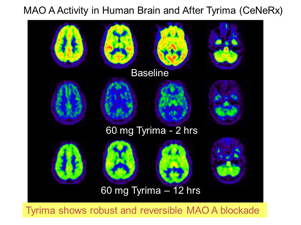 Baseline 60 mg Tyrima - 2 hrs 60 mg Tyrima – 12 hrs MAO A Activity in Human Brain and After Tyrima (CeNeRx) Tyrima shows robust and reversible MAO A blockade