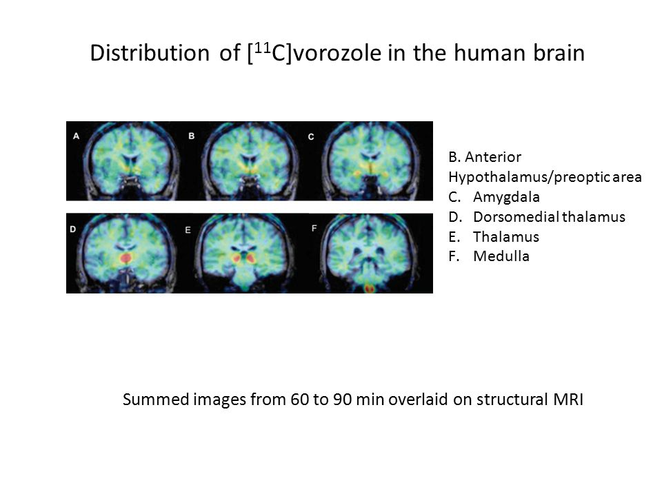 Distribution of [ 11 C]vorozole in the human brain Summed images from 60 to 90 min overlaid on structural MRI B.