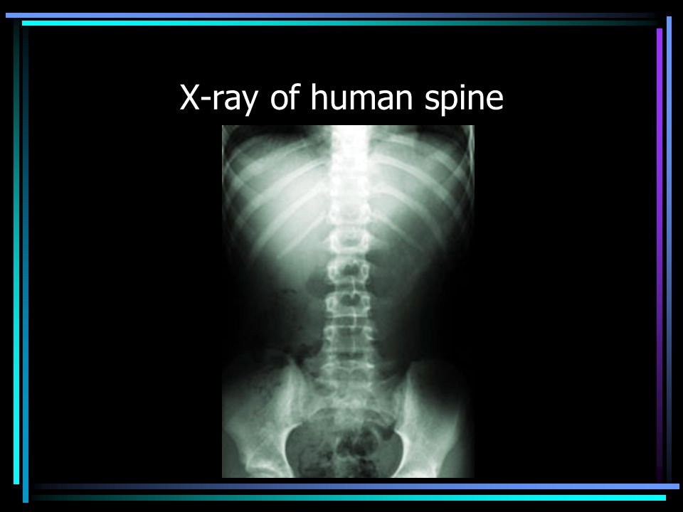 X-ray of human spine